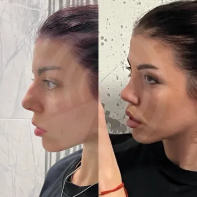 Rhinoplasty
