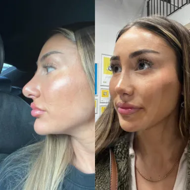 Rhinoplasty