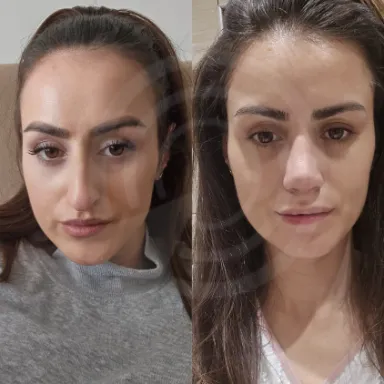 Rhinoplasty