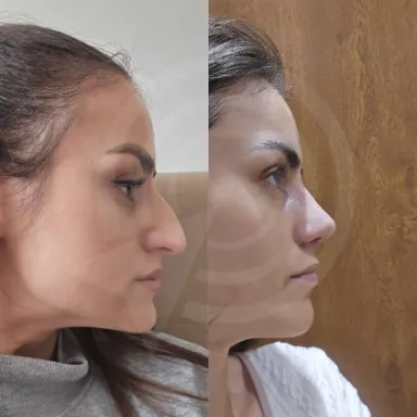 Rhinoplasty