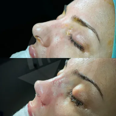 Rhinoplasty