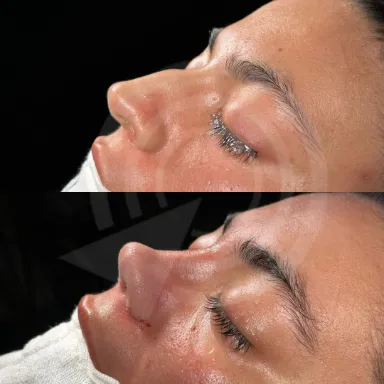 Rhinoplasty