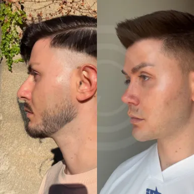 Rhinoplasty