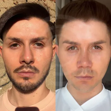 Rhinoplasty