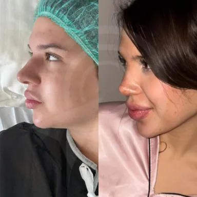 Rhinoplasty