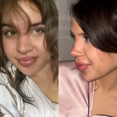 Rhinoplasty
