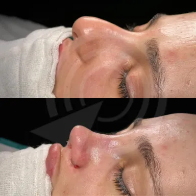 Rhinoplasty