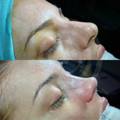 Rhinoplasty