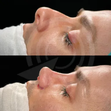 Rhinoplasty