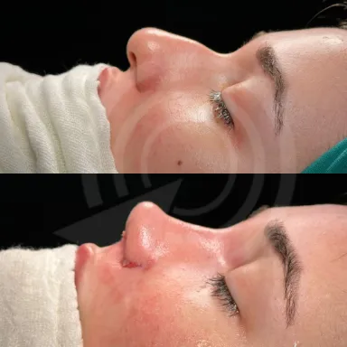 Rhinoplasty
